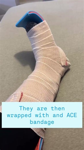 What is a SAM splint?