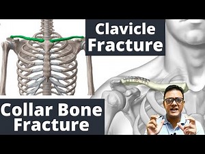 clavicle bone - clavicle fracture - broken collar bone//MANAGEMENT