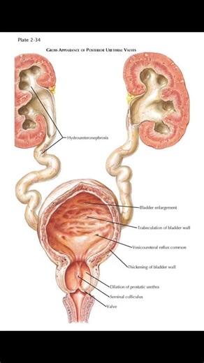Radiology @all abnormalities 🥏🥏 on Instagram: "Ultrasound Examination – Kidneys, Bladder & Pelvis Clinical Presentation: Fever in a 4-month-old male, first episode of urinary tract infection (UTI). Patient Data: Age: 4 months Gender: Male Findings: Bladder: Over-distended urinary bladder with irregular wall thickening. Internal echoes present, suggesting urinary debris / infection. Ureters & Vesicoureteric Junctions (VUJ): Bilateral dilated ureters (hydroureter) reaching up to kidneys. Wide ve