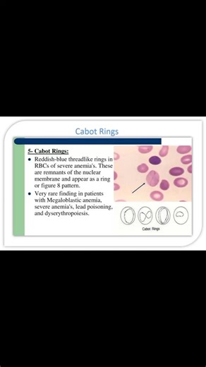 Rose Apple on Instagram: "💐Cabot ring💍 💐An RBC inclusion seen on peripheral blood smear. ✅ Appearance: Thin ring, oval, or figure-of-eight structure inside the red blood cell. ✅Thought to be remnants of mitotic spindles, microtubules, or nuclear material. 💐Conditions associated with Cabot rings 🔸Megaloblastic anemia 🔸Lead poisoning 🔸Severe anemia 🔸Sideroblastic anemia 🔸Dyserythropoiesis (e.g., myelodysplastic syndrome, leukemia) 👉 Cabot rings are ring- or figure-of- eight–shaped inclus