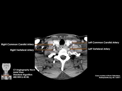 Neck Vasculature on CT Scans (Axial)