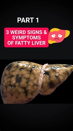7.5K views · 37 reactions | 3 WEIRD SIGNS & SYMPTOMS OF FATTY LIVER PART 1 喙⚠️ Not all symptoms of fatty liver are obvious. Watch Part 1 to learn about three unusual signs your liver might be struggling. Stay informed and take care! #fattyliver #liver #FattyLiver #LiverHealth #HealthAwareness #WellnessTips #FattyLiverSymptoms #BodySignals #LiverCare #HealthyLiving #MedicalInfo #DigestiveHealth | Diet & healthy By Dr | Facebook