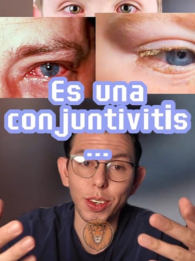 ¿Qué necesitas saber sobre la conjuntivitis?
