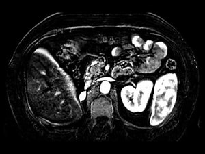 RCC metastasis to adrenal