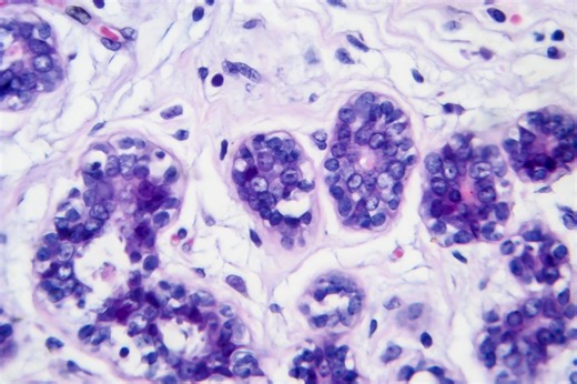 Mangrove GS: un algorithme qui prédit le risque de propagation des cancers | RTS