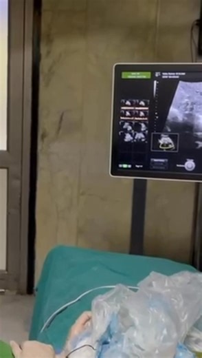 Have you ever worked with ultrasound-guided percutaneous microwave ablation (MWA) for second-trimester selective fetal reduction in complicated monochorionic pregnancies? In this video, Dr. Anita Kaul performs this technique at Apollo Hospitals, a leading tertiary care center in India and one of the most established units in North India for managing complex pregnancies and in-utero fetal therapies. Monochorionic twin pregnancies are associated with unique complications due to the shared placenta