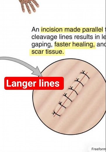 Surgical incision - langer lines