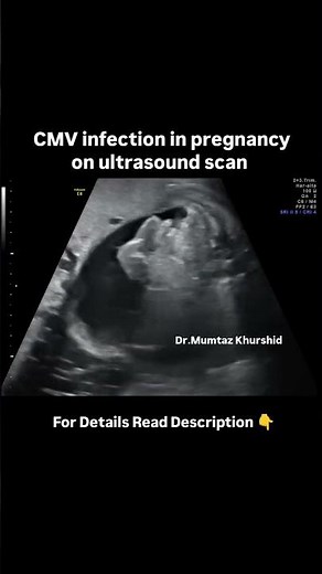CMV infection In Pregnancy Ultrasound Findings