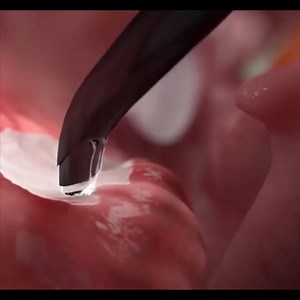 Tonsillectomy and Adenotonsillectomy | Doctor Lisa