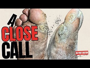 A Close Call: Trimming A Thick Callus On A Patient With Diabetes