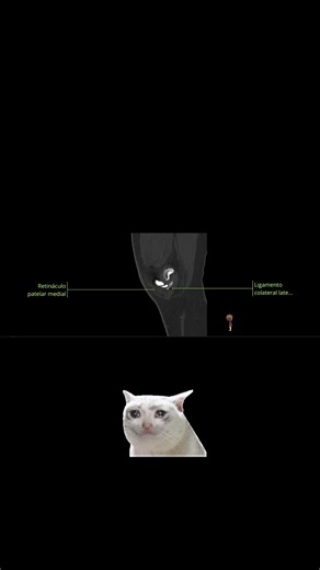 🦵 La rodilla parece simple… hasta que intentas identificar cada estructura en una resonancia magnética. Meniscos, ligamentos, cartílago, tendones y hueso trabajan como un sistema perfectamente coordinado. Conocer su anatomía es la base para detectar lesiones con confianza. 👀 Reto rápido: ¿Cuántas estructuras puedes nombrar sin leer las etiquetas? 📚 Los mejores intérpretes de imágenes no empiezan estudiando patologías, empiezan dominando la anatomía normal. 💬 Te leo en comentarios: ¿Qué estru