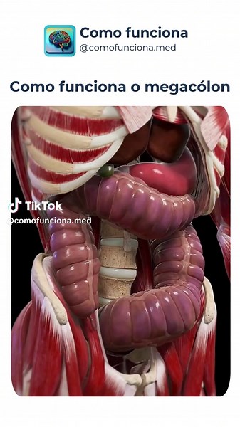 Como funciona o megacolon: causas e consequências