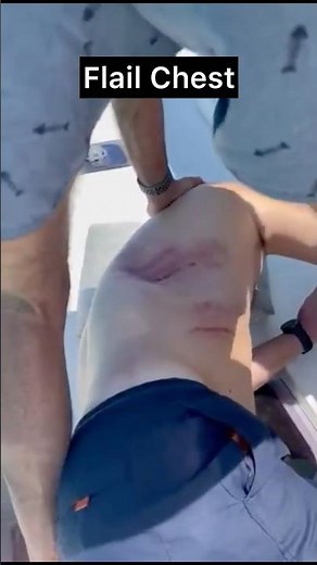 Flail Chest: The Deadly Chest Injury You Need to Recognize! #flailchest