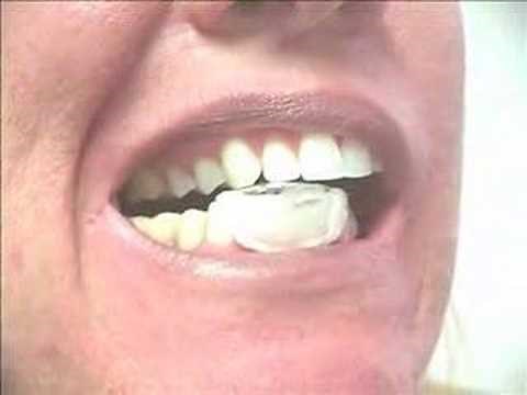 NTI fabrication using ThermoPlasticPutty