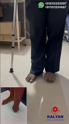 Prosthetic silicone foot for partial foot amputation.