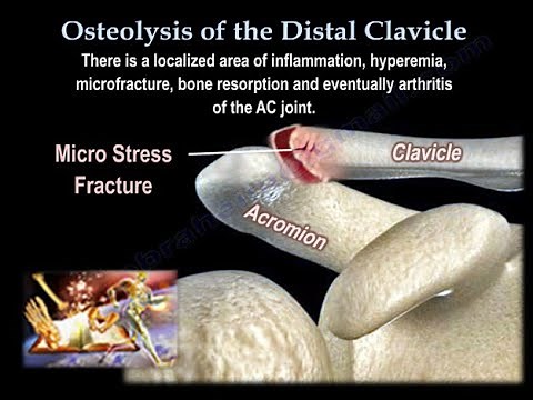 Osteolysis Of The Distal Clavicle - Everything You Need To Know - Dr. Nabil Ebraheim
