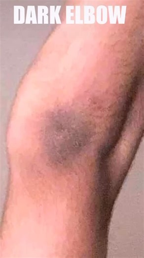 Kirti Singh on Instagram: "Comment “Recipe” for the link💞 . . . [ skincare, pigmentation, homemadesoap, pimples, acne ] . . . . #skincare #soap #skin #pigmentation #acne #darkspot"