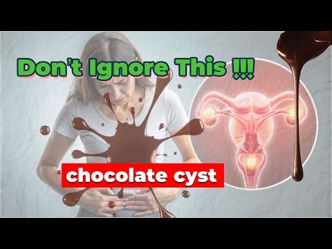 What is Endometrioma?