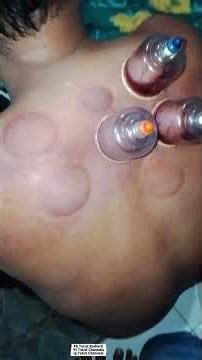 Cara bekam basah sederhana dirumah #bekamsehat #bekambasah #therapist #therapistreflexy #