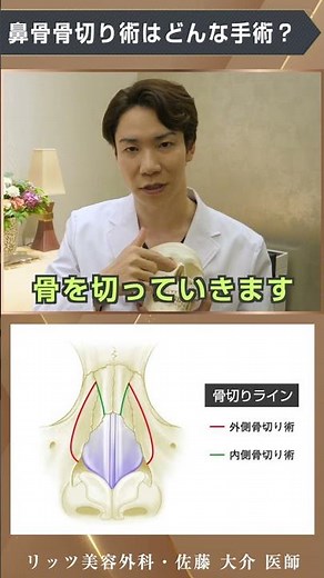 曲がった鼻を治す方法を教えます！鼻骨骨切り術とは？ #shorts