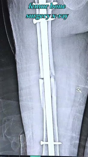 femur bone surgery x-ray #trendingshorts #anatomy #trendingshorts #anatomy