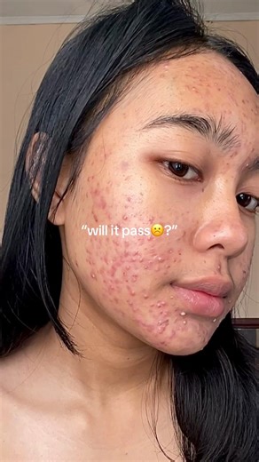 now i’m also struggling with PCOS. #pcos #acne #pcosawareness