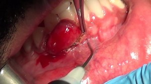 irritation fibroma excision with diode laser :) :) By Dr. Khaled Asaad :) #Dentistry #The_Genius_prof | The Genius Prof