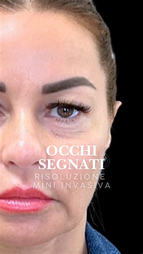 Carlo Graziani on Instagram: "✨Dagli Stati Uniti all’Italia✨ Grazie alle tecniche mini-invasive, il recupero dell'intervento chirurgico è stato molto rapido: Sara 10 giorni dopo l’operazione mostrava già risultati visibili, e a 2 mesi l’evoluzione del suo sguardo era sorprendente. ♥︎ Grazie Sara per averci scelto e per aver affrontato questo lungo viaggio per raggiungerci. ✨From the United States to Italy✨ Thanks to our minimally invasive techniques, Sara’s recovery was very quick: just 10 days 