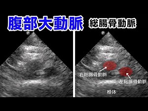 総腸骨動脈【POCUS・ポイントオブケア超音波】