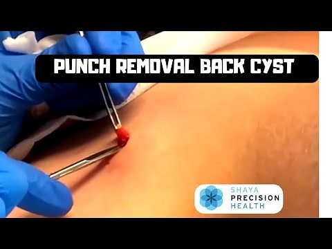 BACK CYST REMOVED THROUGH PUNCH BIOPSY HOLE