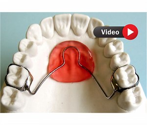 ¿Qué es el Botón de Nance? ¿Cómo se confecciona?