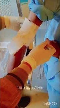 What is banding and how is it done?