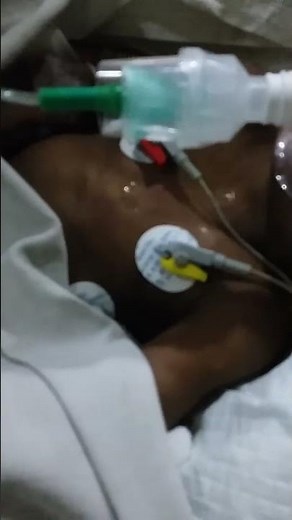Stridor in a post extubated child