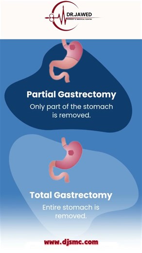 Gastrectomy Surgery: What to Expect & How to Prepare 🏥✨