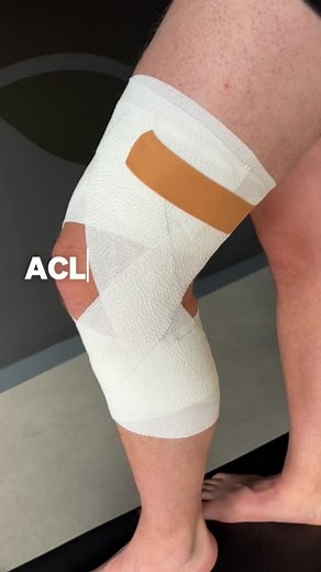 ACL strapping 👇 This one’s not about stopping a rupture. It’s about support and feedback. We’re applying the principles of taping to the ACL, but those posterior-anterior strips aren’t likely to prevent a stretch on the ligament. ✅ What it will do: provide proprioceptive feedback to help you move with more confidence... | Sporttape