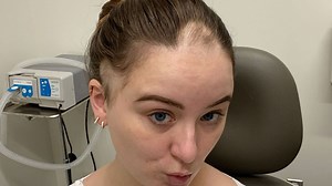 My hair started thinning and now I have a comb-over for my bald spot at 25