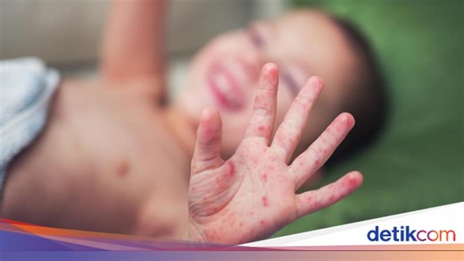 Apa Itu Virus Campak? Ini Pengertian, Penyebab, dan Cara Penularannya