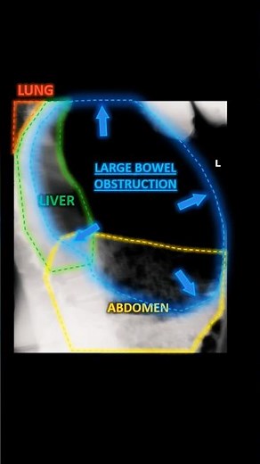 🚨HUGE BOWEL OBSTRUCTION on X-Ray🚨