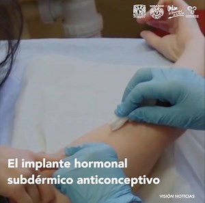 79K views · 850 reactions | Este método anticonceptivo tiene una efectividad de 99% y una duración de 5 años | Facultad de Medicina UNAM | Facebook