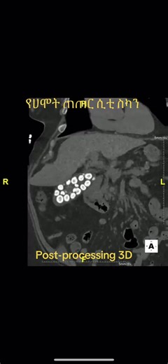 79 year old female presenting with right sided abdominal pain, cramping, nausea and vomiting. Post-processing via 3D imaging software, was performed using images from her CT scan for better visualization of her abdomen. This revealed numerous Gallstones (Cholelithiasis). #RADዮጵያ #3D #educational #CTSCAN