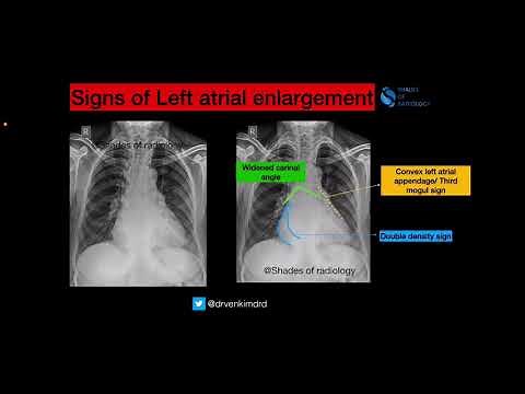 Classic signs of Left atrial enlargement on plain Chest radiograph