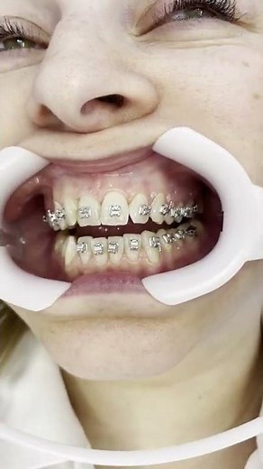 Zahnspange Erwachsene - Brackets kleben #shorts