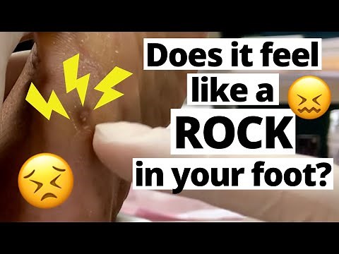 Does It Feel Like a Rock Is In Your Foot?? This Is Why (SUPER DEEP CORN REMOVAL)