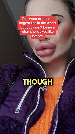 409K views · 1.5K reactions | Largest lips in the world #health #rare #lesson #shocking #foryou #viralreels #viral #storytelling #story #thedailydoc #facebookreels #usa #interesting | The Daily Doc | Facebook