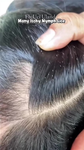 How to Remove Lice Safely at Home: Step-by-Step Lice Removing Guide