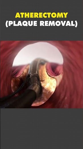 Atherectomy Procedure 3D Animation – How Plaque Is Removed from Arteries
