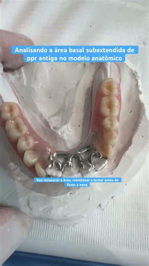 Prótese parcial removível subextendida #ppr