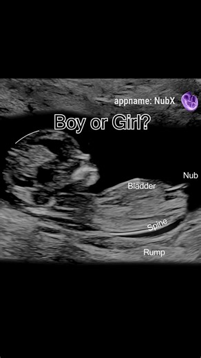 Understanding Baby's Nub in Ultrasound Scans