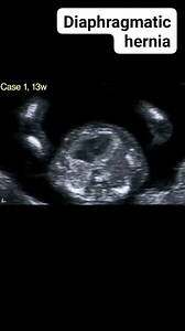 Diaphragmatic hernia | Radiology Interesting Cases
