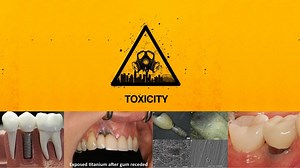 Titanium Toxicity - Emerginnova